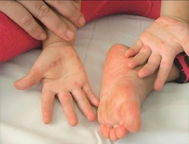 Tay chân miệng độ 1 thường biểu hiện bằng những đốm đỏ trên da